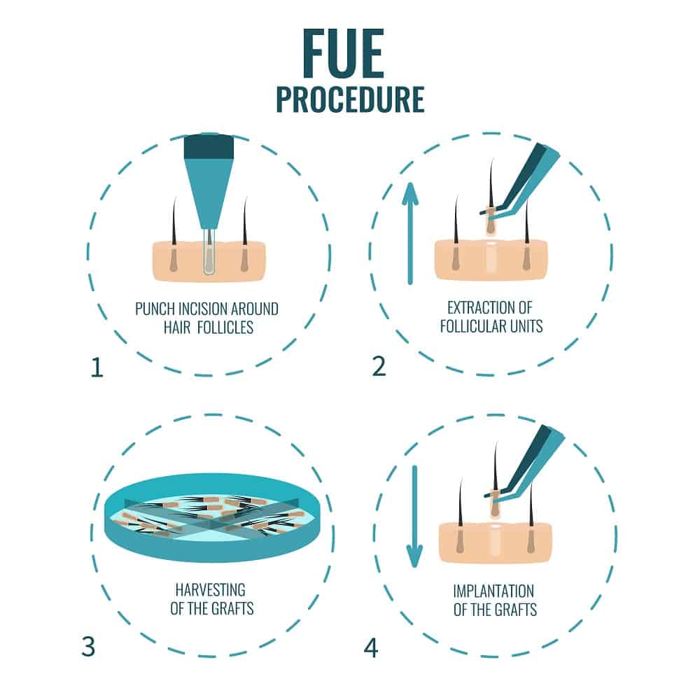 Follicular Unit Extraction (FUE)