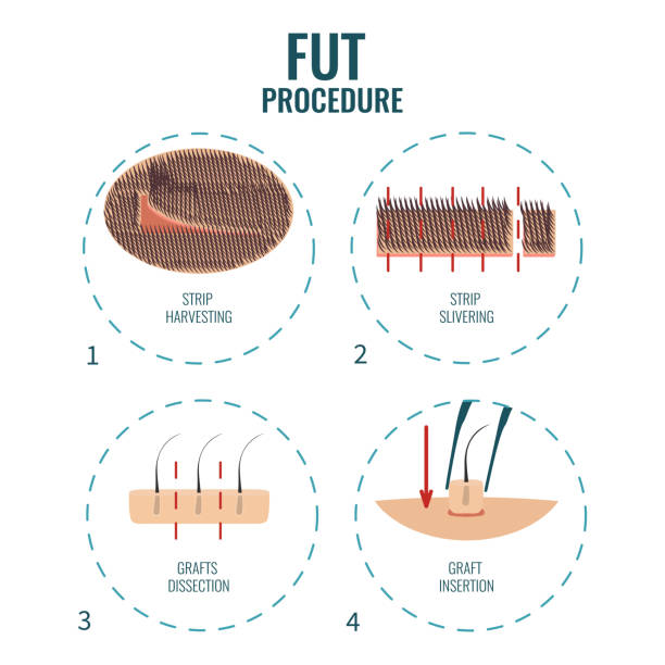 Follicular Unit Transplantation (FUT)